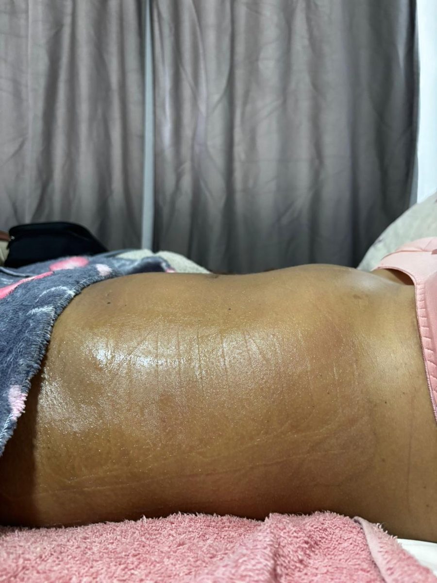 Taping aplicado no abdômen no pós-parto