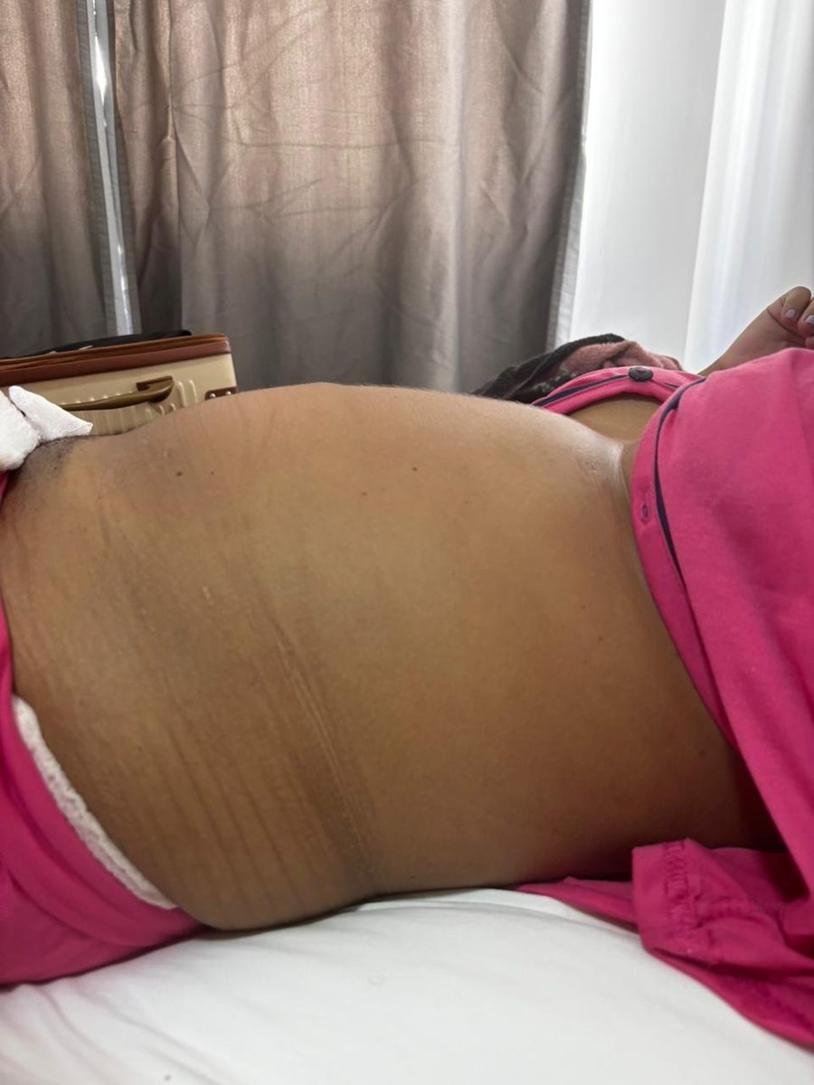 Resultado da bandagem de taping pós-parto